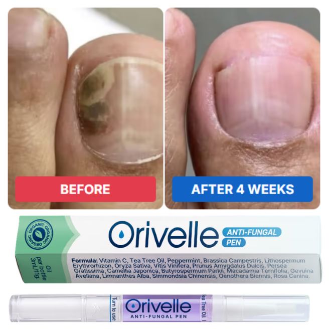 Orivelle nail appearance comparison image Orivelle nail appearance comparison image