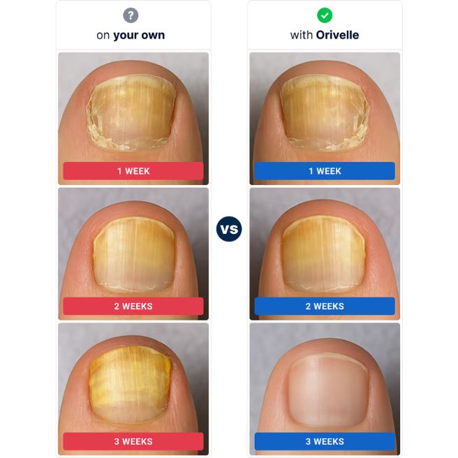 Orivelle nail appearance progression graphic Orivelle nail appearance progression graphic